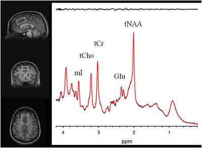 Antigliadin Antibodies (AGA IgG) Are Related to Neurochemistry in Schizophrenia